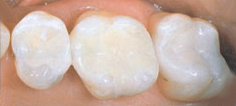 Perfect Smile composite restorations